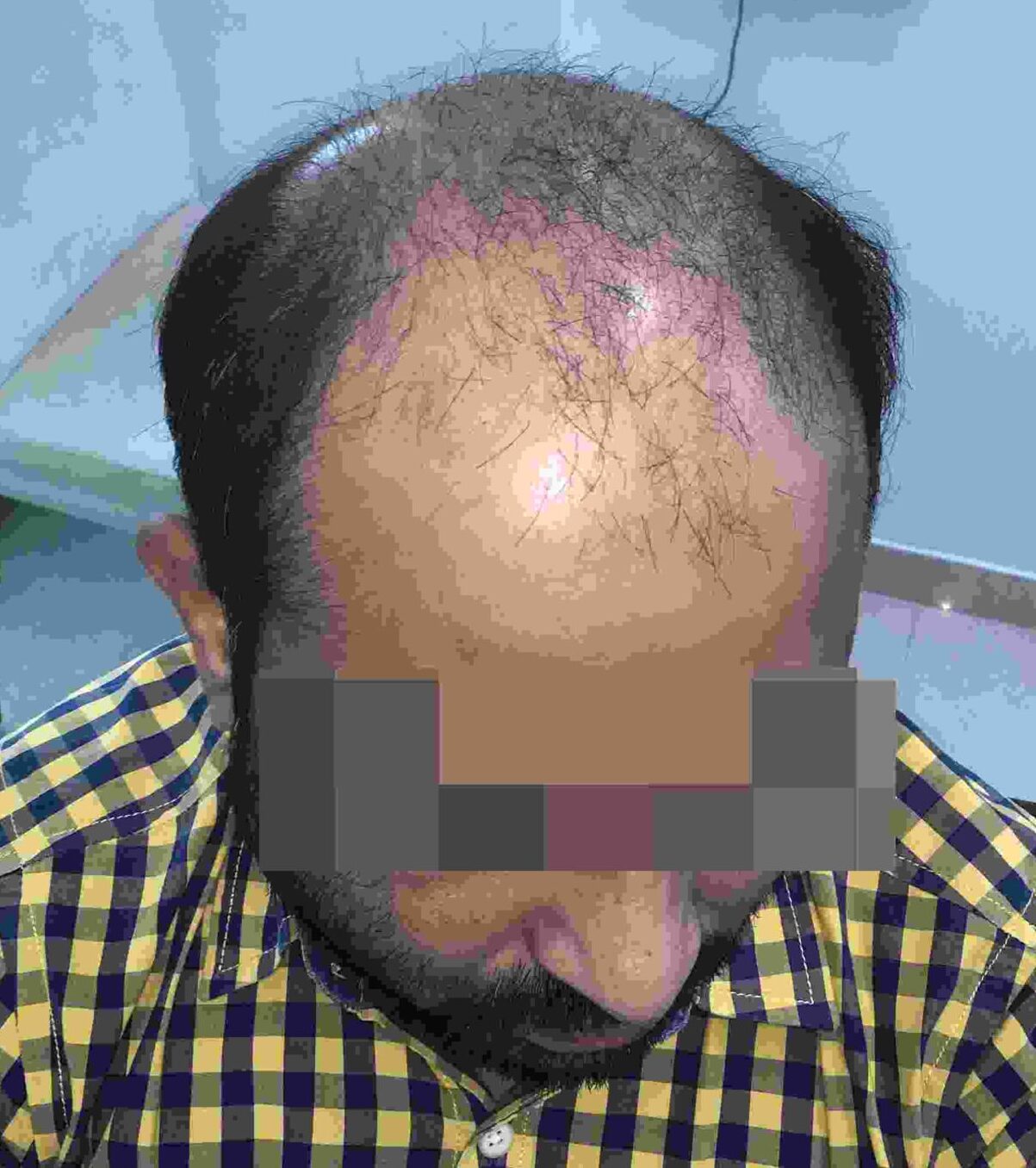 best hair transplant in delhi 
