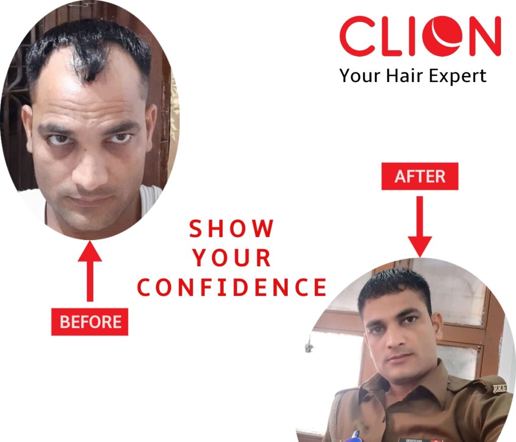 Best Hair Transplant Clinic in Ahmedabad Cost & Review – Best Hair Help