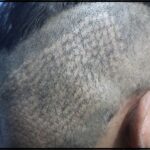 hair transplant scar