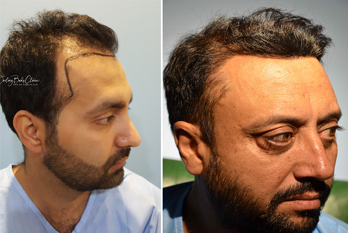 best hair transplant chandigarh – Best Hair Help