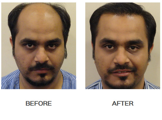 Enhance Clinic Kolkata Review – Hair Transplant Cost In Enhance – Best Hair  Help