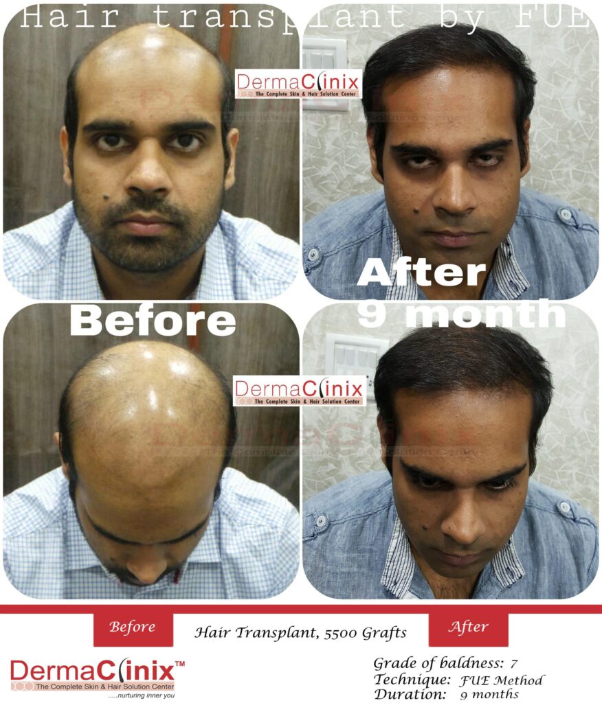 Dermaclinix Clinic Delhi Review – Hair Transplant Cost In Dermaclinix –  Best Hair Help