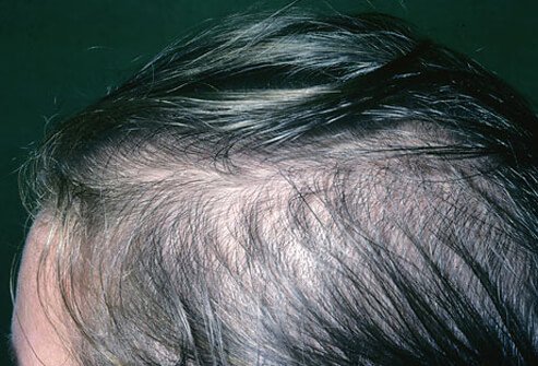covid-triggers-hair-loss