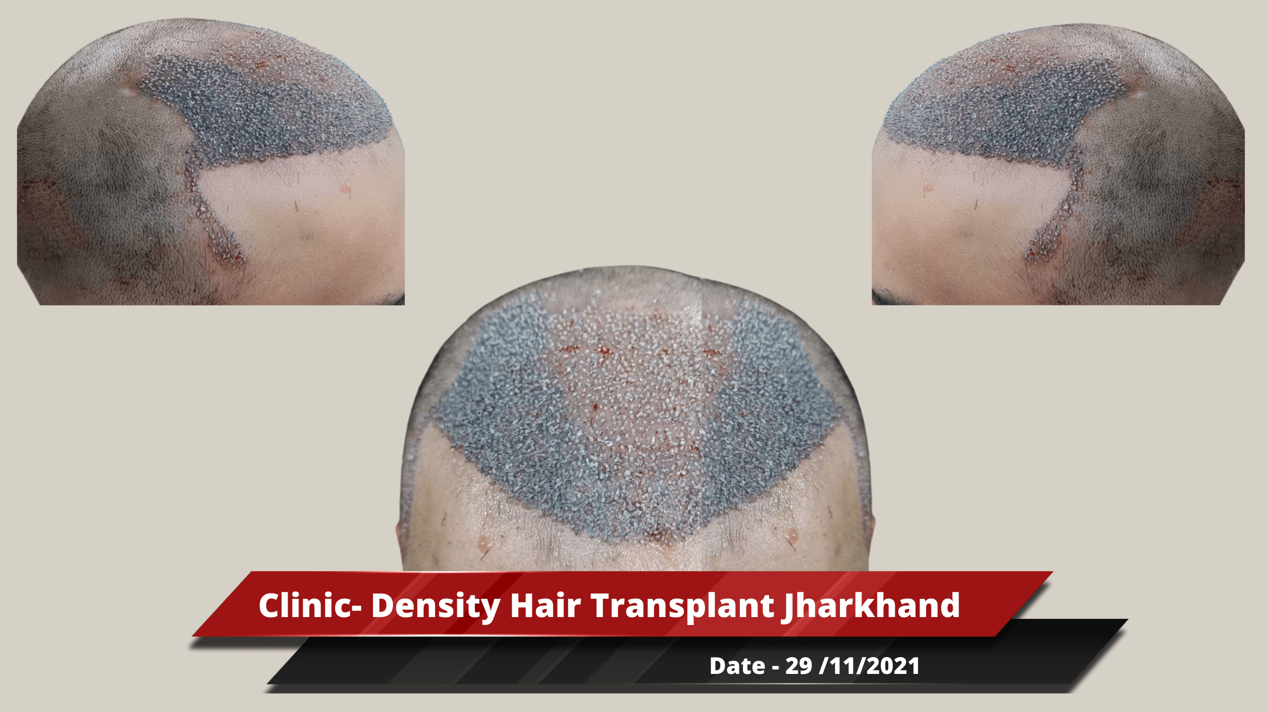 Clinic- Density Hair Transplant Jharkhand-min
