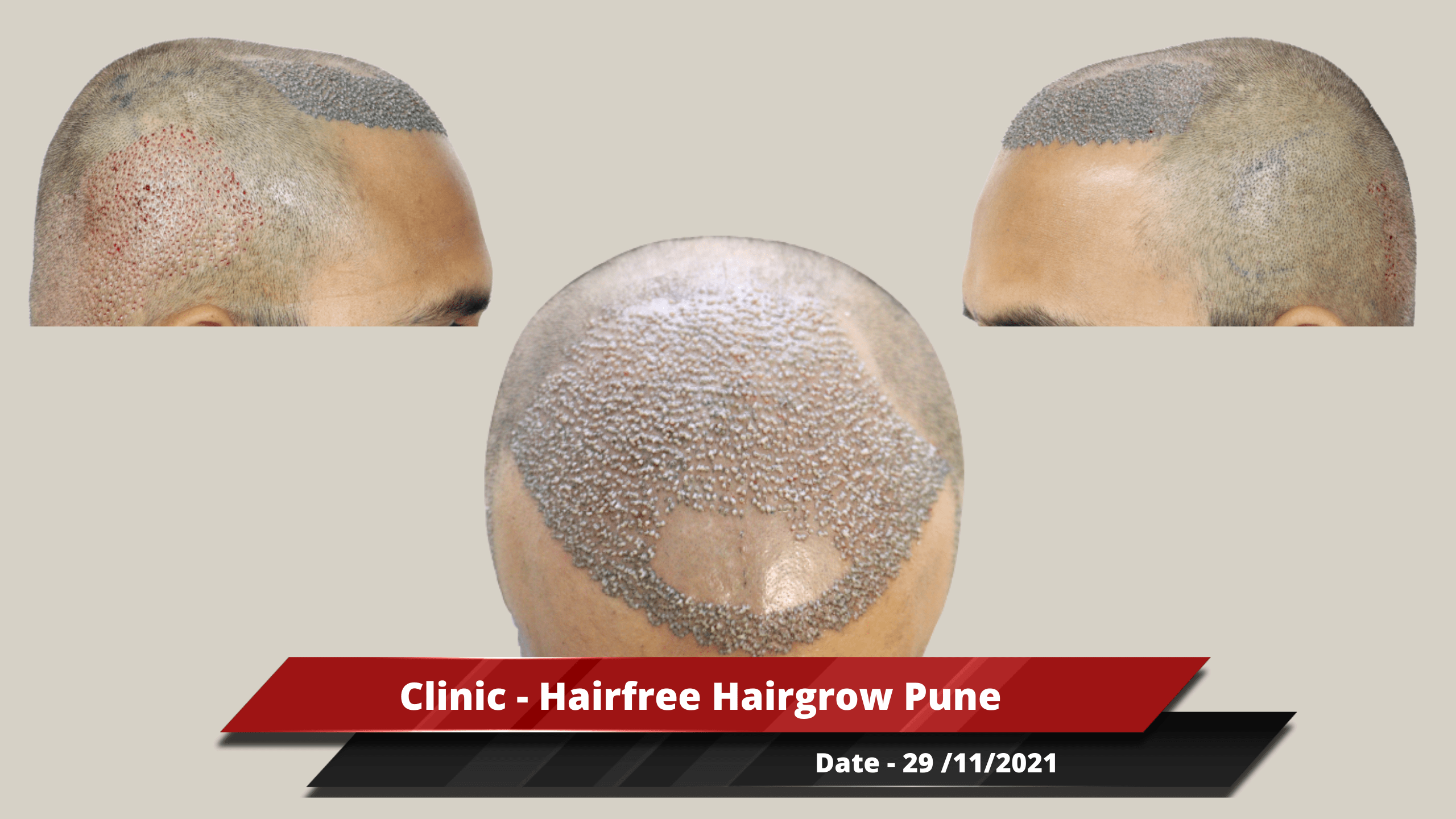 Clinic - Hairfree Hairgrow Pune-min