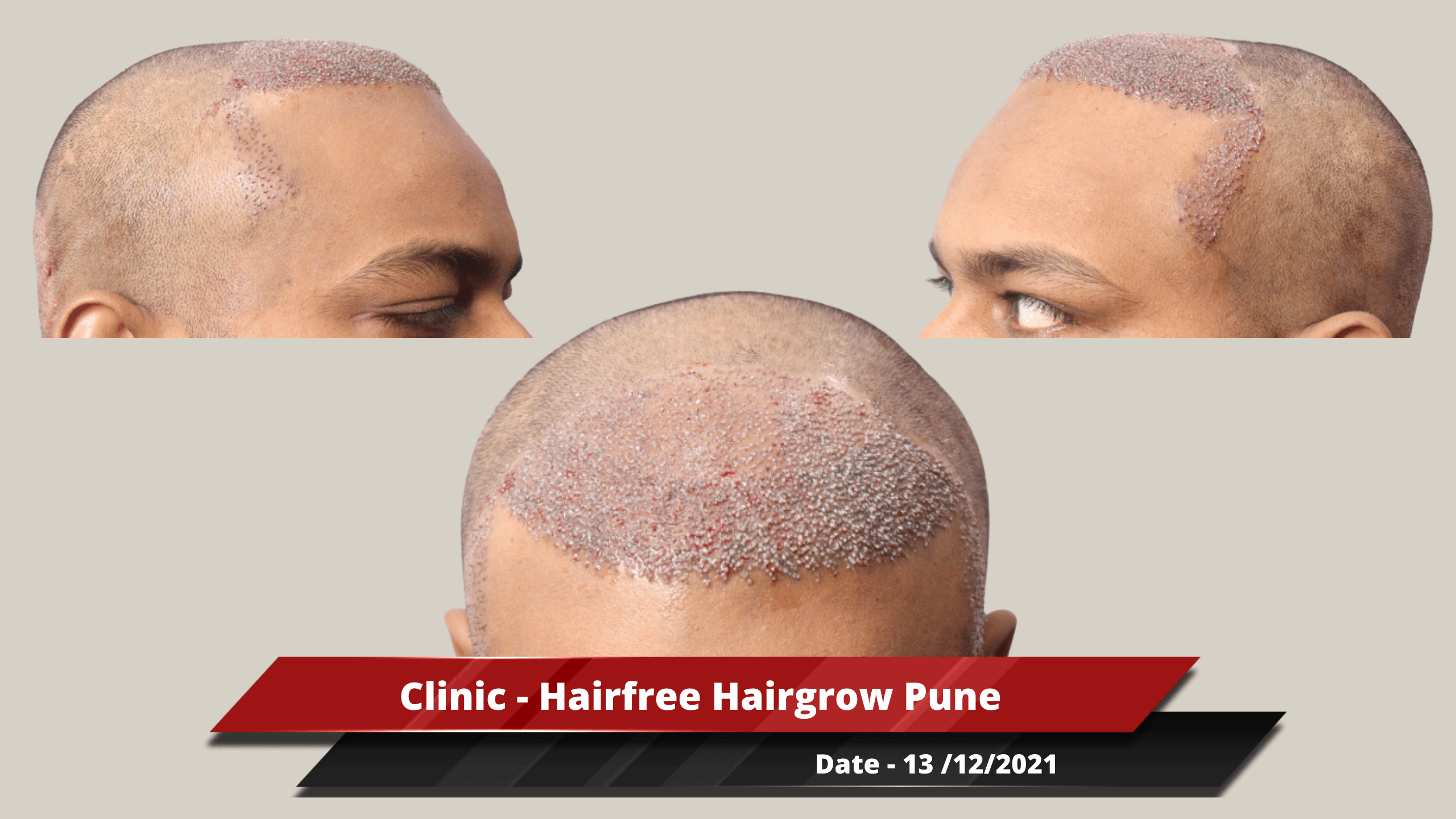 Clinic - Hairfree Hairgrow Pune-min_1