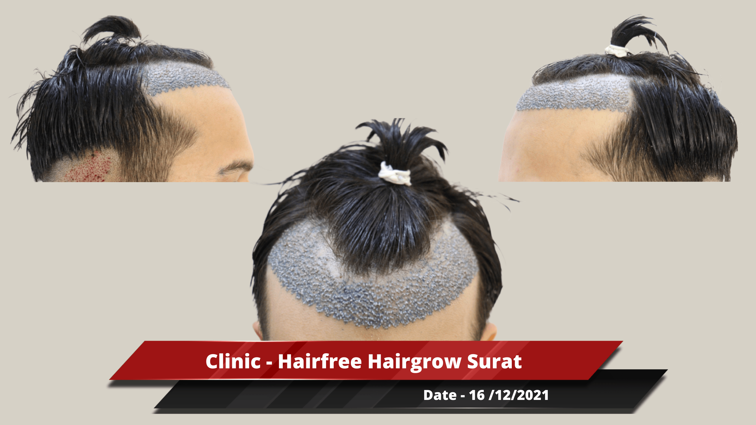 Clinic - Hairfree Hairgrow Surat-min