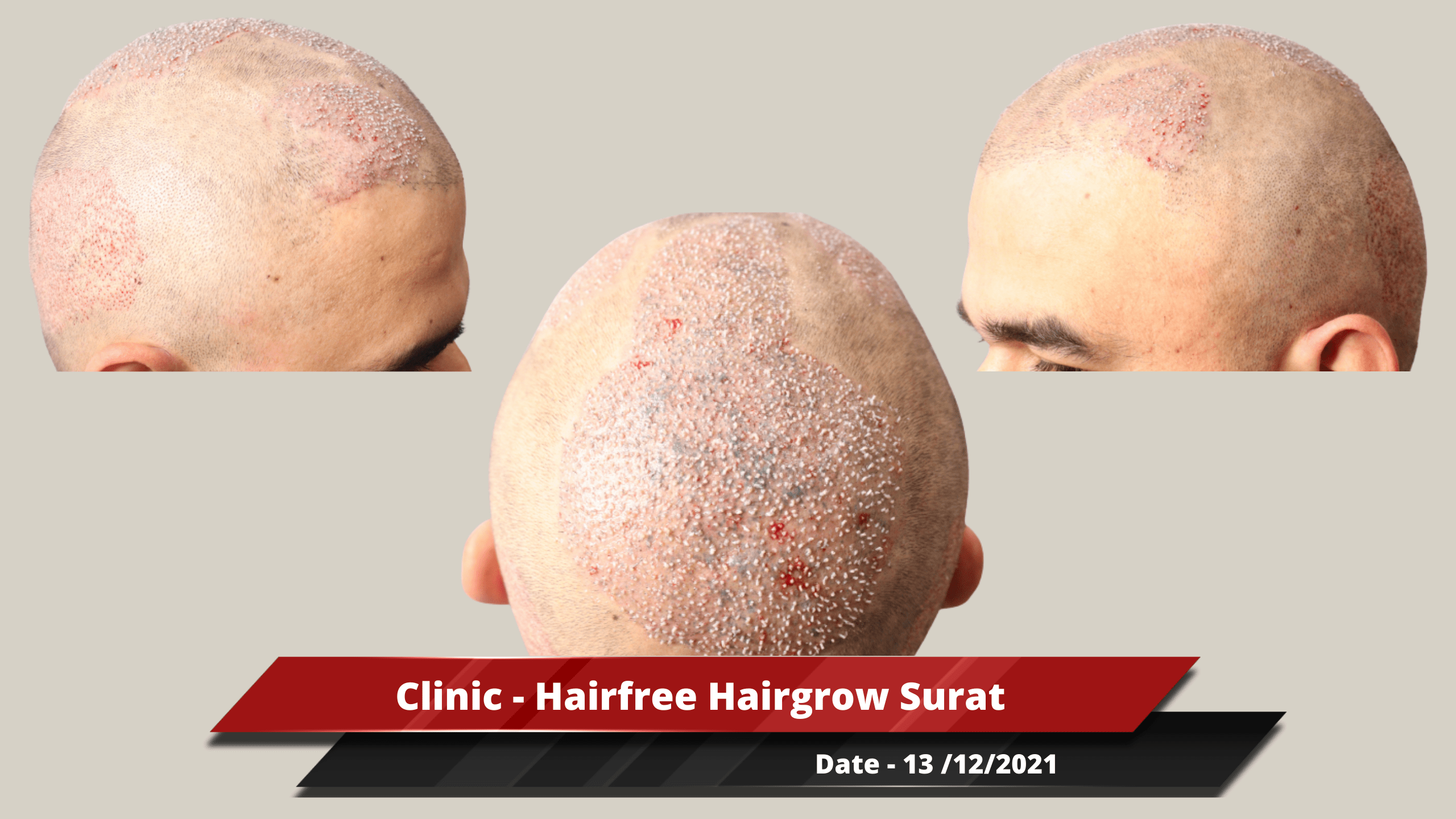 Clinic - Hairfree Hairgrow Surat-min_1