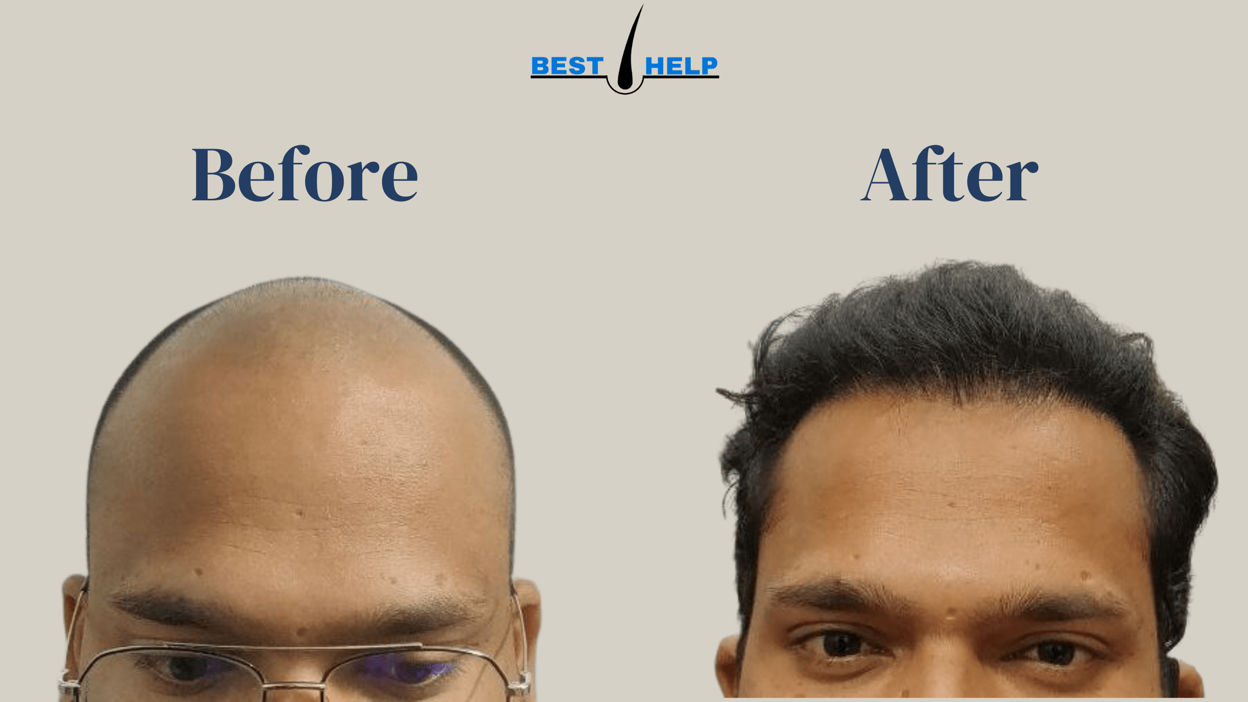 Density Hair transplant clinic: A Hidden Gem of the Hair Transplant  Industry – Best Hair Help