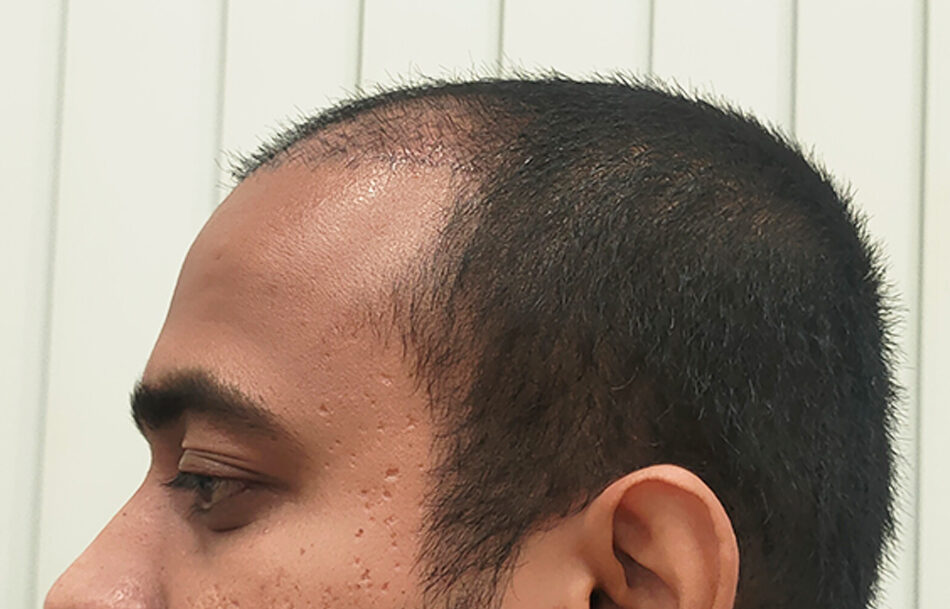 A Natural Hair Transplant Result From Mumbai – Best Hair Help