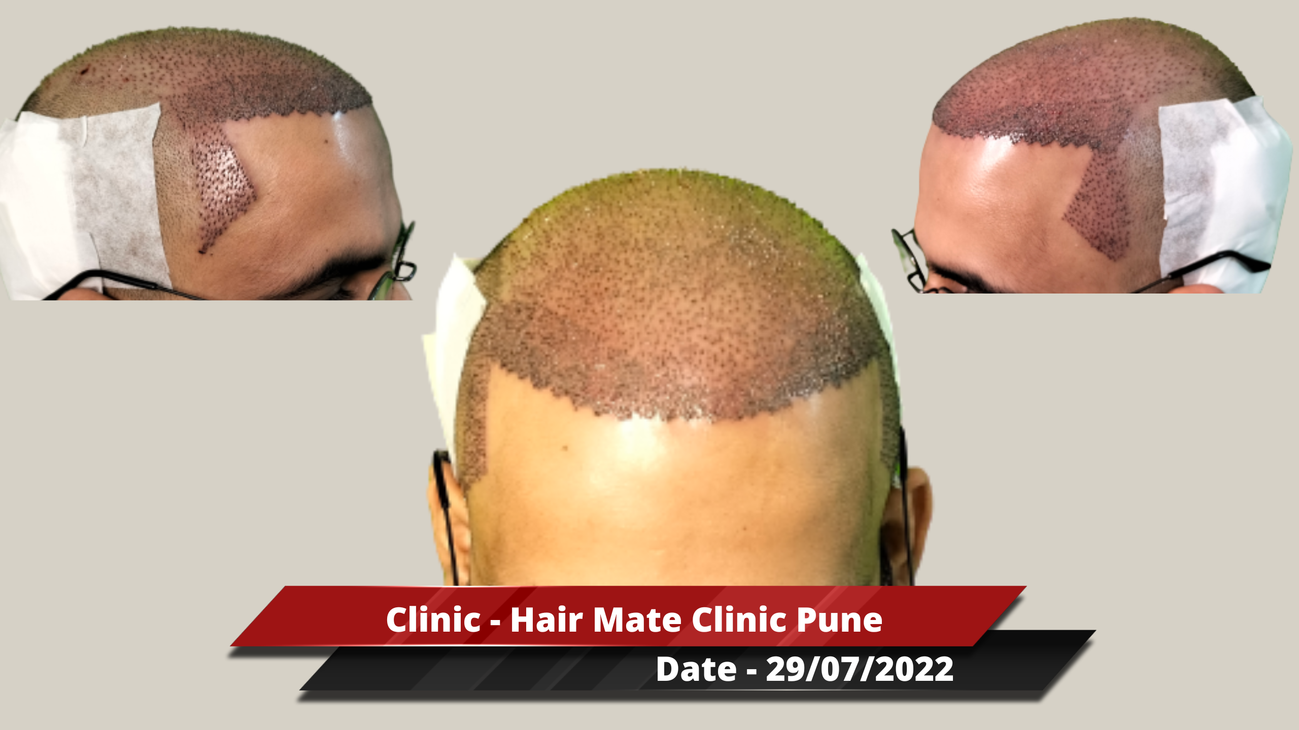 Hair Transplant from Pune Clinic – 3800 Grafts – Best Hair Help