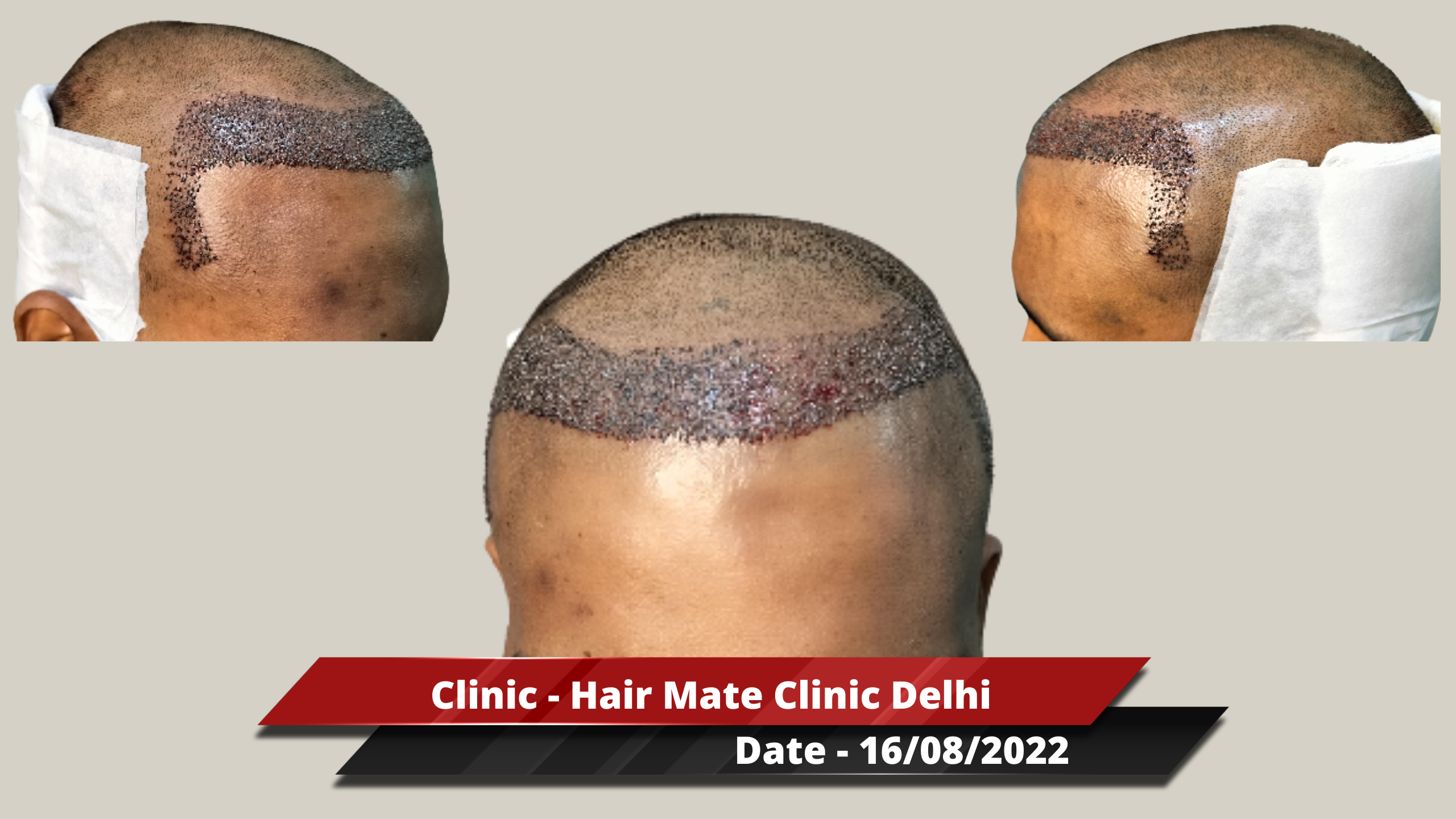 Hair Transplant from Delhi Clinic – 2300 Grafts – Best Hair Help