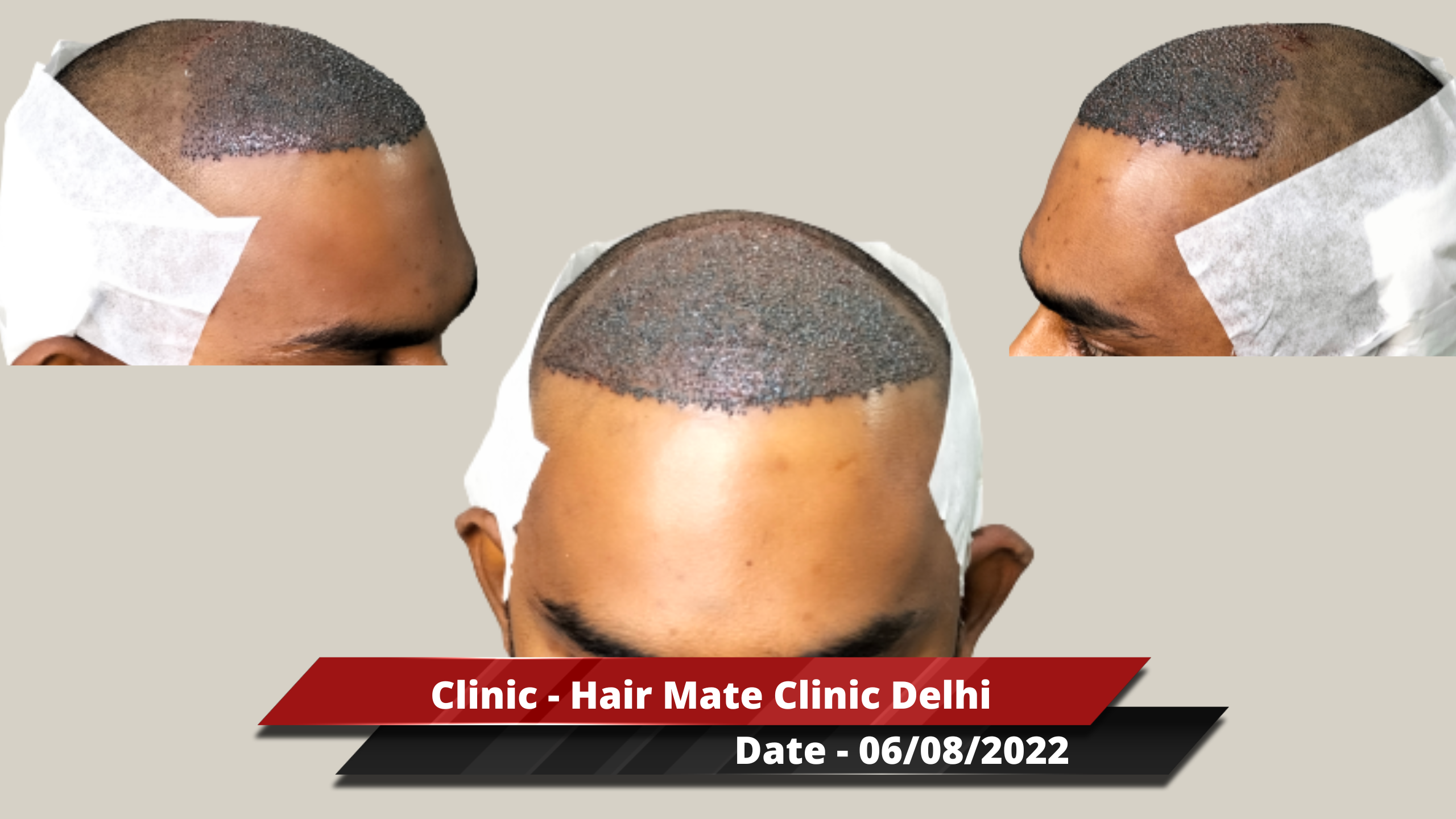 Hair Transplant from Delhi Clinic – 3500 Grafts – Best Hair Help