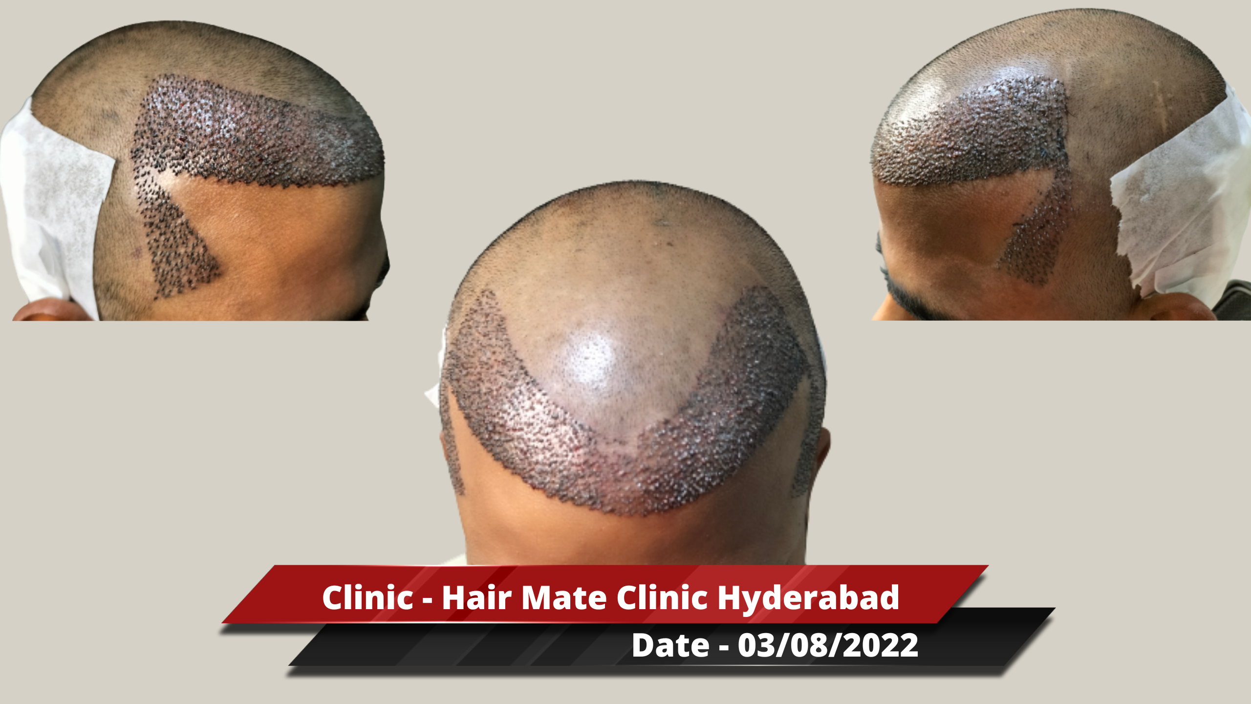 Hair Transplant from Hyderabad Clinic 2600 Grafts Best Hair Help