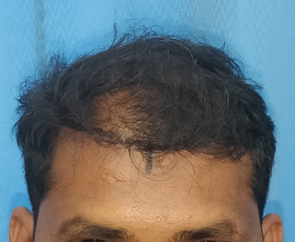 Hair Transplant from Pune Clinic – 1900 Grafts – Best Hair Help