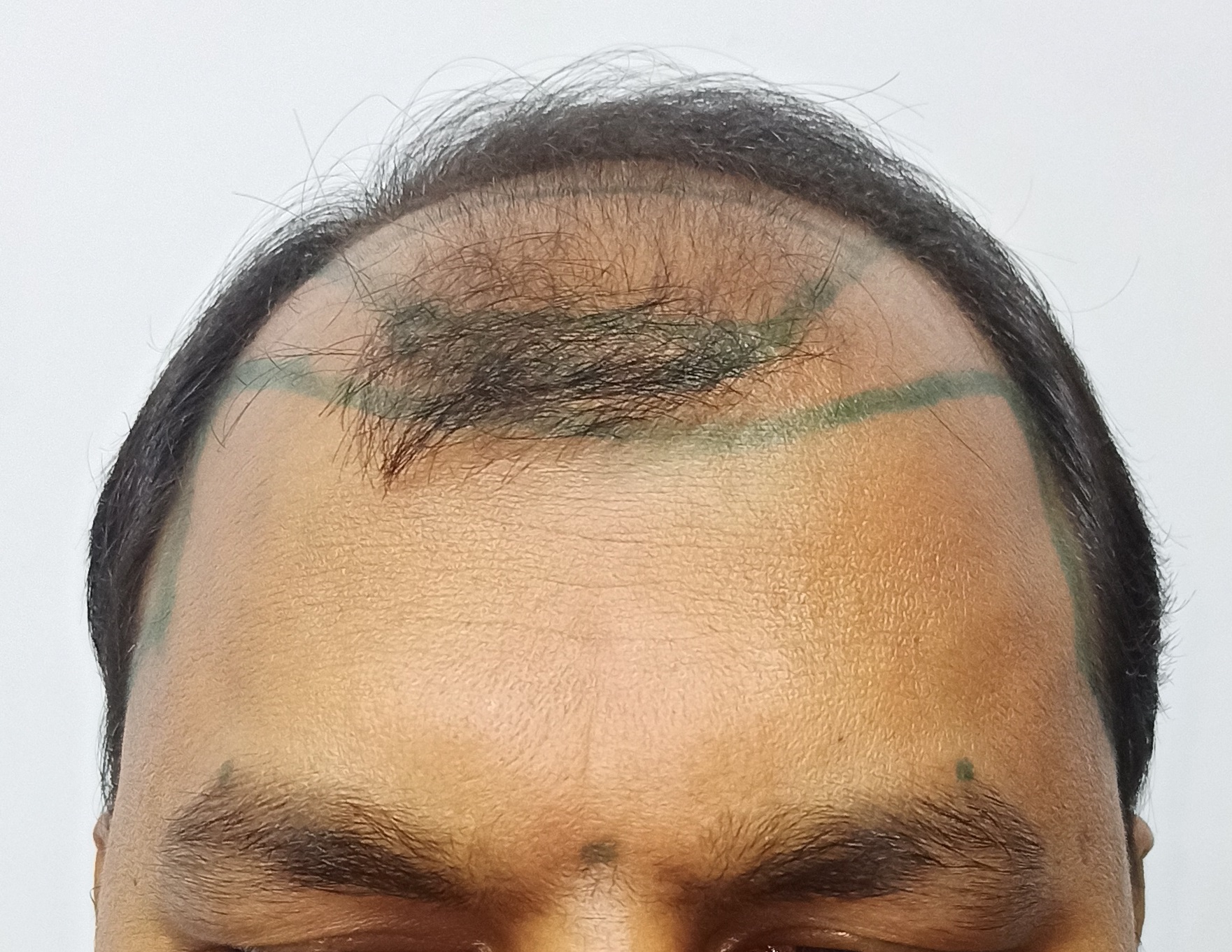 Hair Transplant from Kolkata Clinic – 4200 Grafts – Best Hair Help