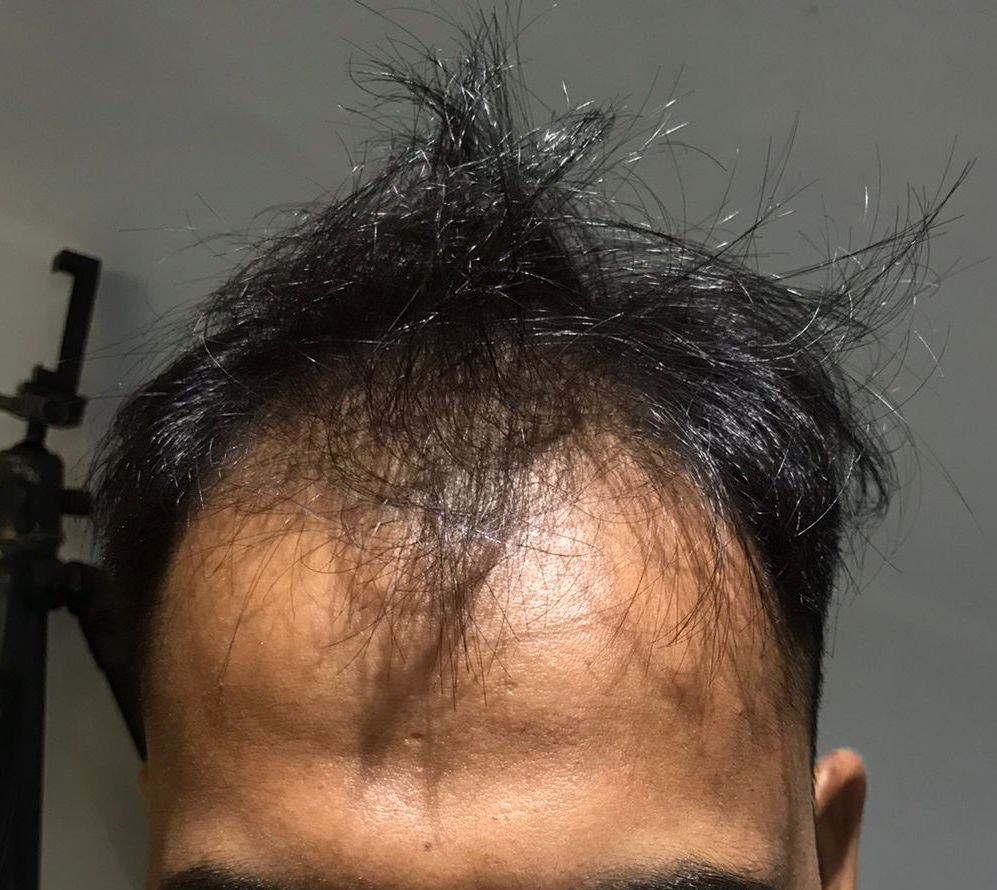 Hair Transplant from Hyderabad Clinic – 3200 Grafts – Best Hair Help