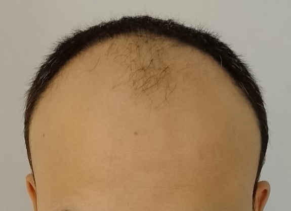 Hair Transplant from Delhi Clinic – 3700 Grafts – Best Hair Help