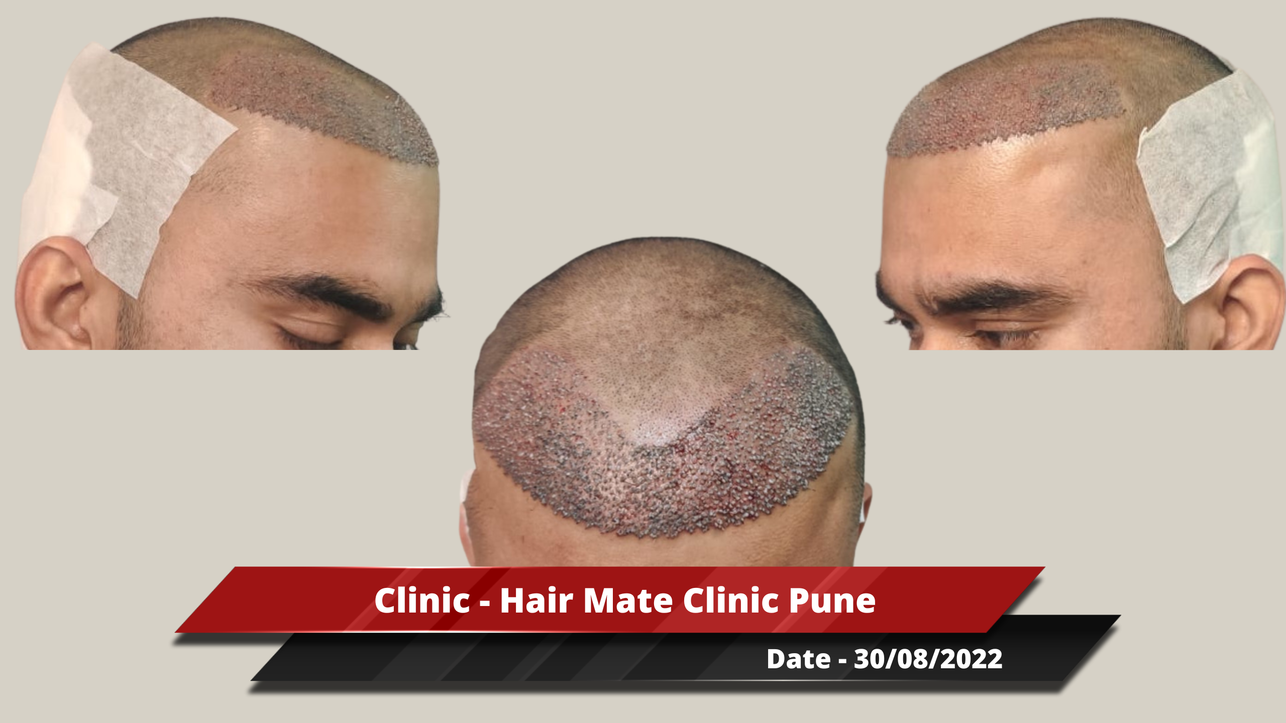 Hair Transplant from Pune Clinic – 2000 Grafts – Best Hair Help