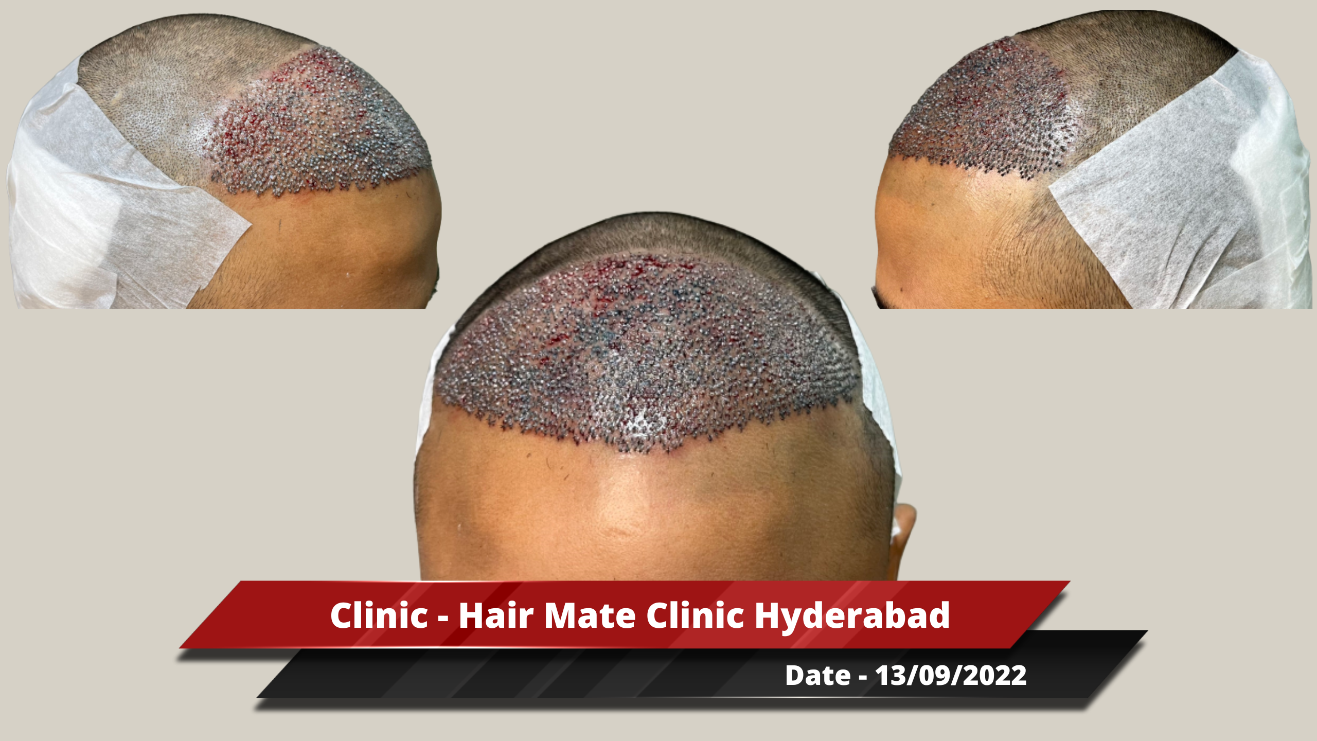 Hair Transplant from Hyderabad Clinic – 3000 Grafts – Best Hair Help