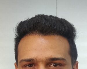 A Natural Hair Transplant Result From Ahmedabad