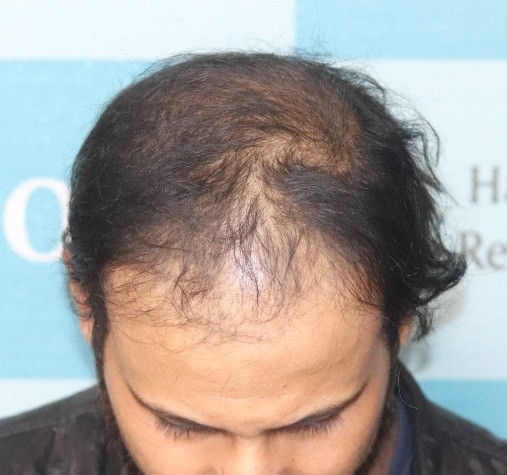 A Natural Hair Transplant Result From Haridwar – Best Hair Help