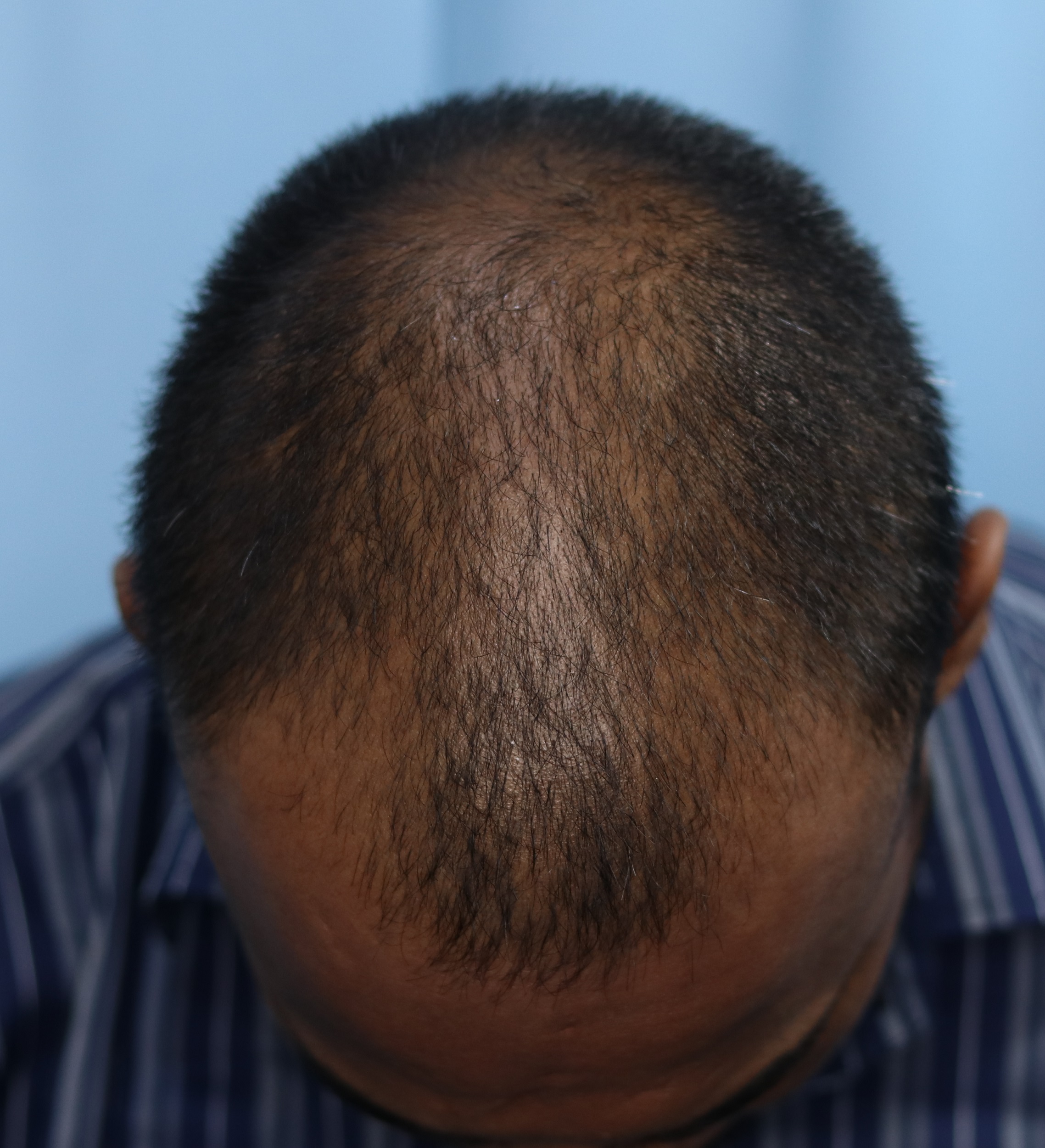 A Natural Hair Transplant Result From Haridwar – Best Hair Help