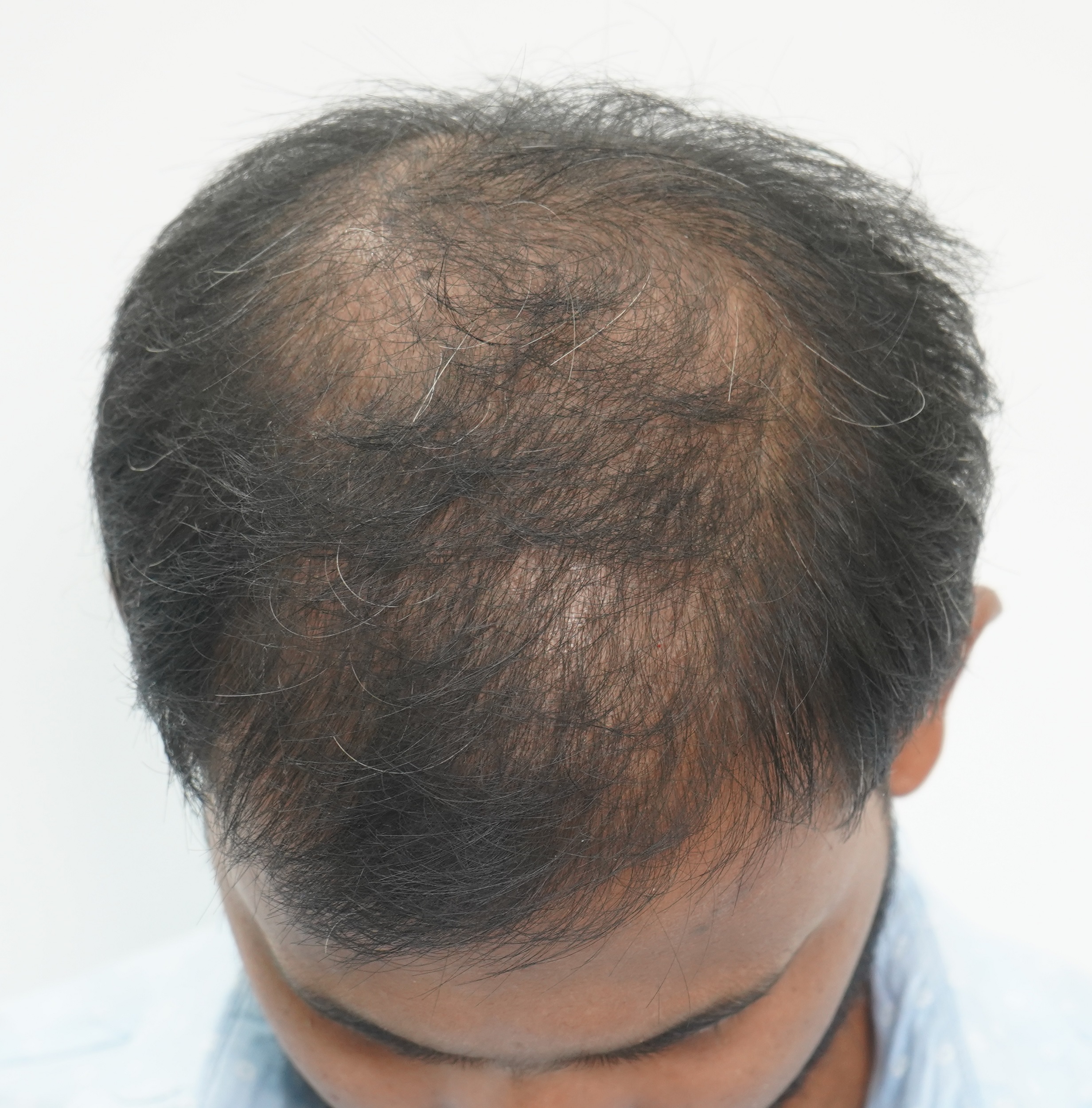 Hair Transplant from Pune Clinic 2900 Grafts Best Hair Help