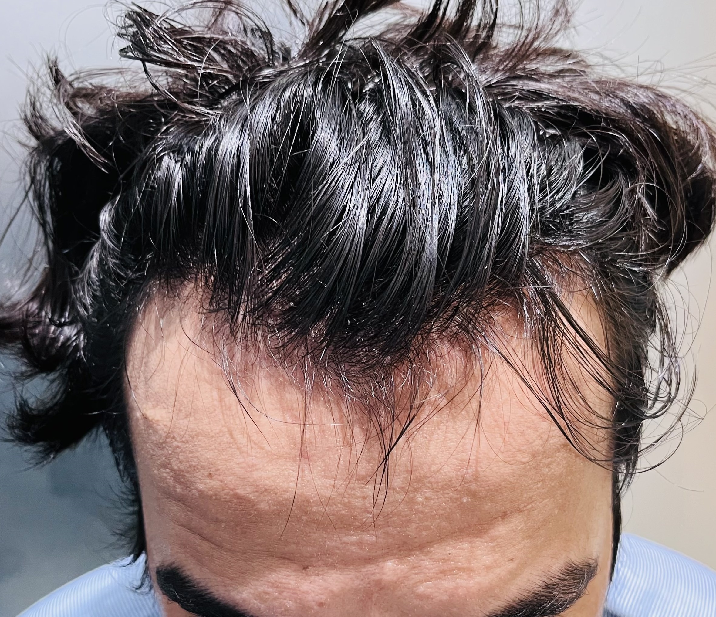 Hair Transplant from Pune Clinic 2500 Grafts Best Hair Help