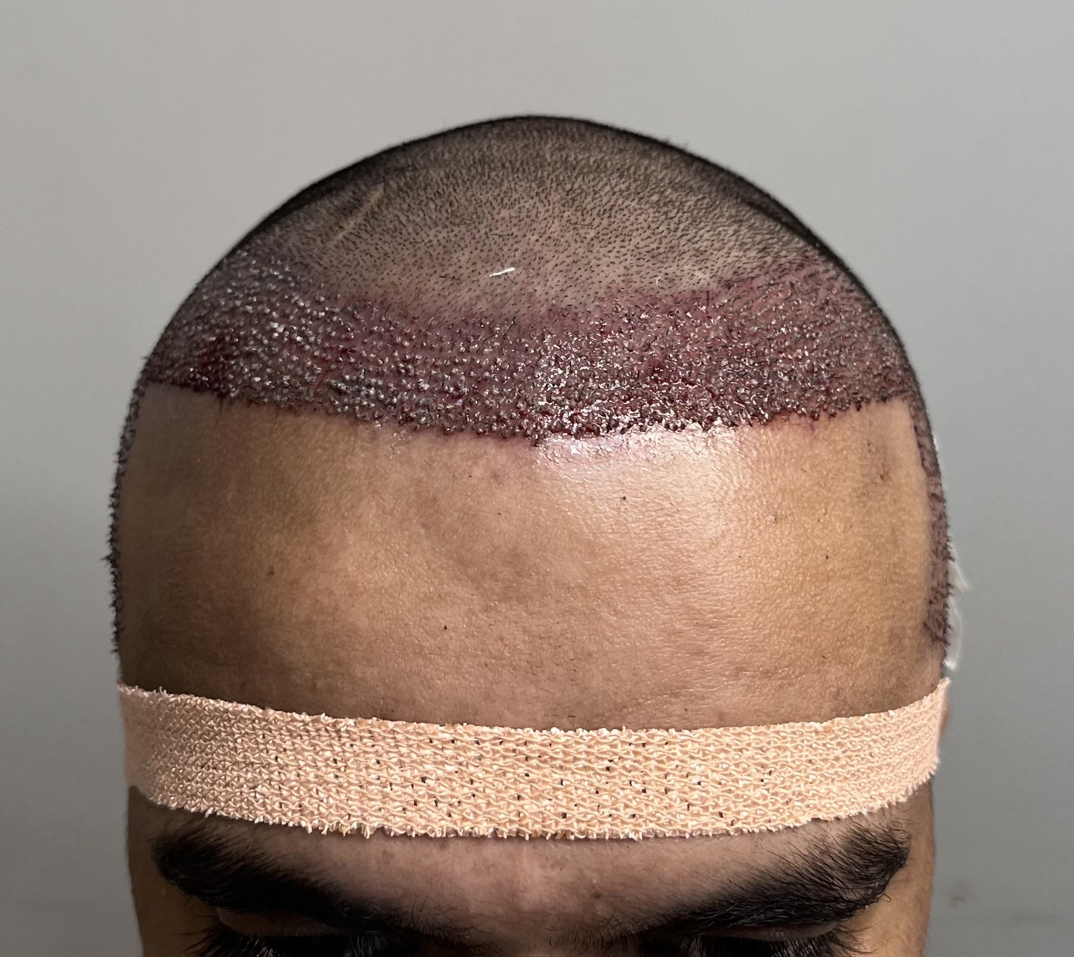 Hair Transplant from Pune Clinic 2500 Grafts Best Hair Help