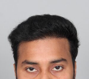 A Natural Hair Transplant Result From Haridwar