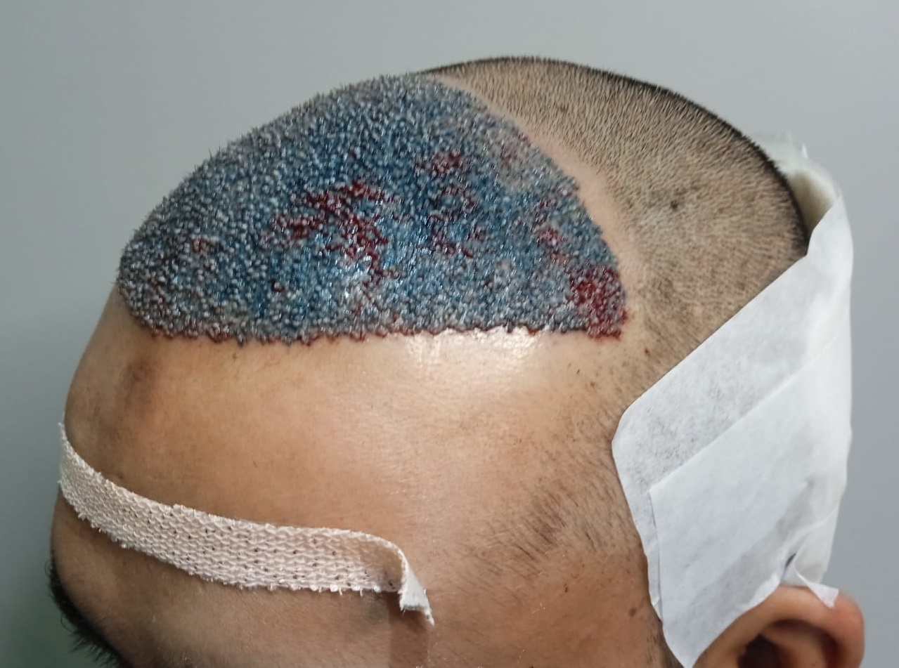 Hair Transplant from Pune Clinic – 3500 Grafts – Best Hair Help