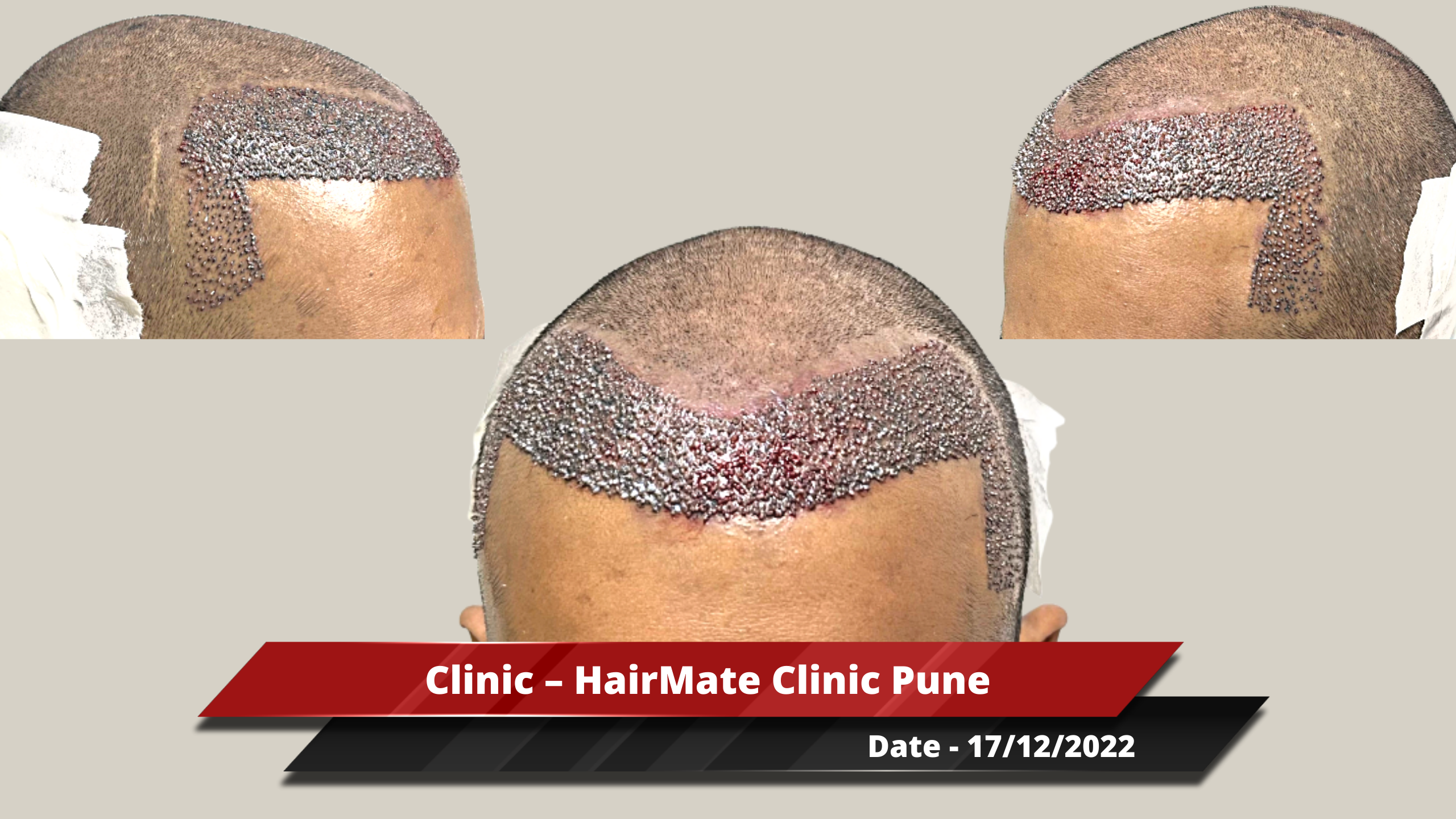 Hair Transplant from Pune Clinic – 2500 Grafts – Best Hair Help