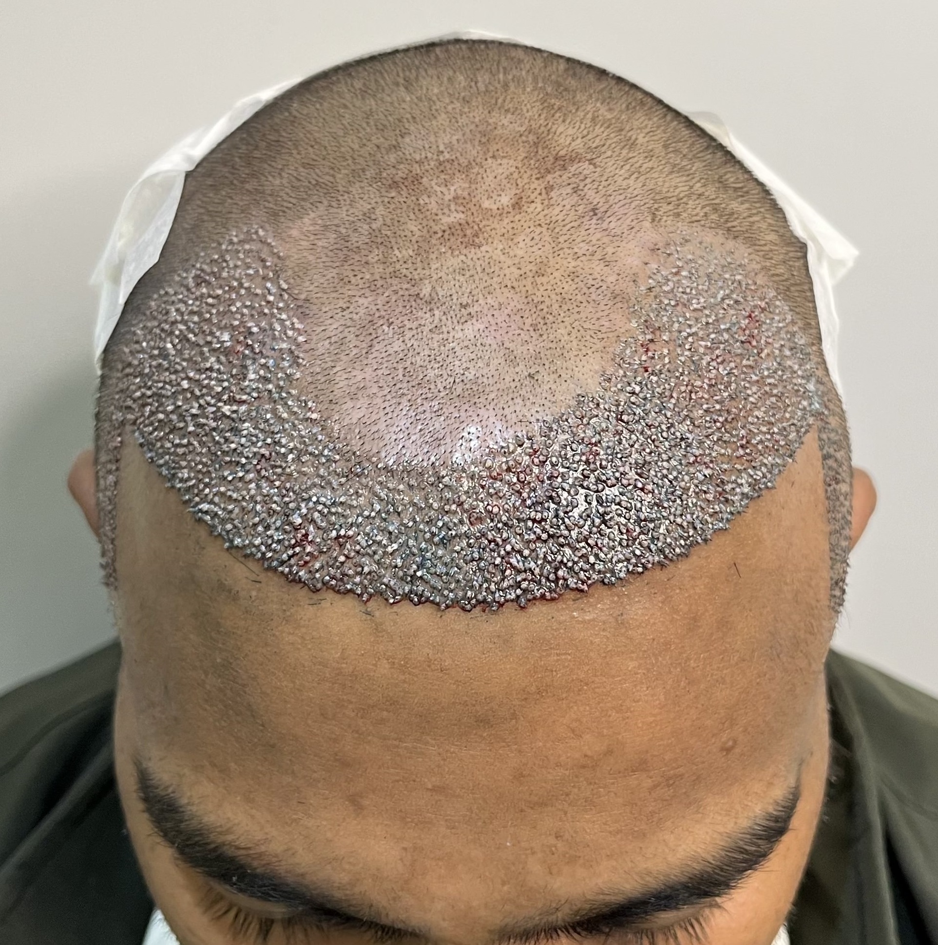 Hair Transplant from Delhi Clinic – 2700 Grafts – Best Hair Help