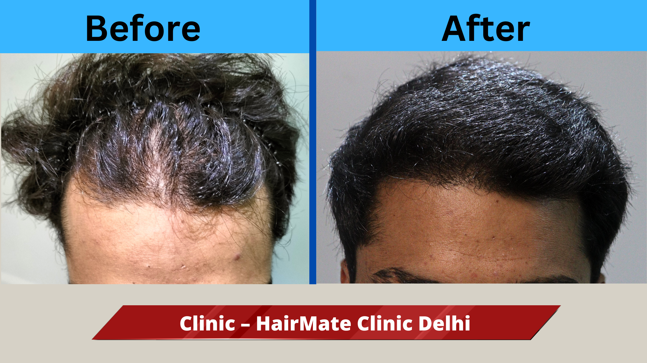 best hair tranaplant result in india – Best Hair Help