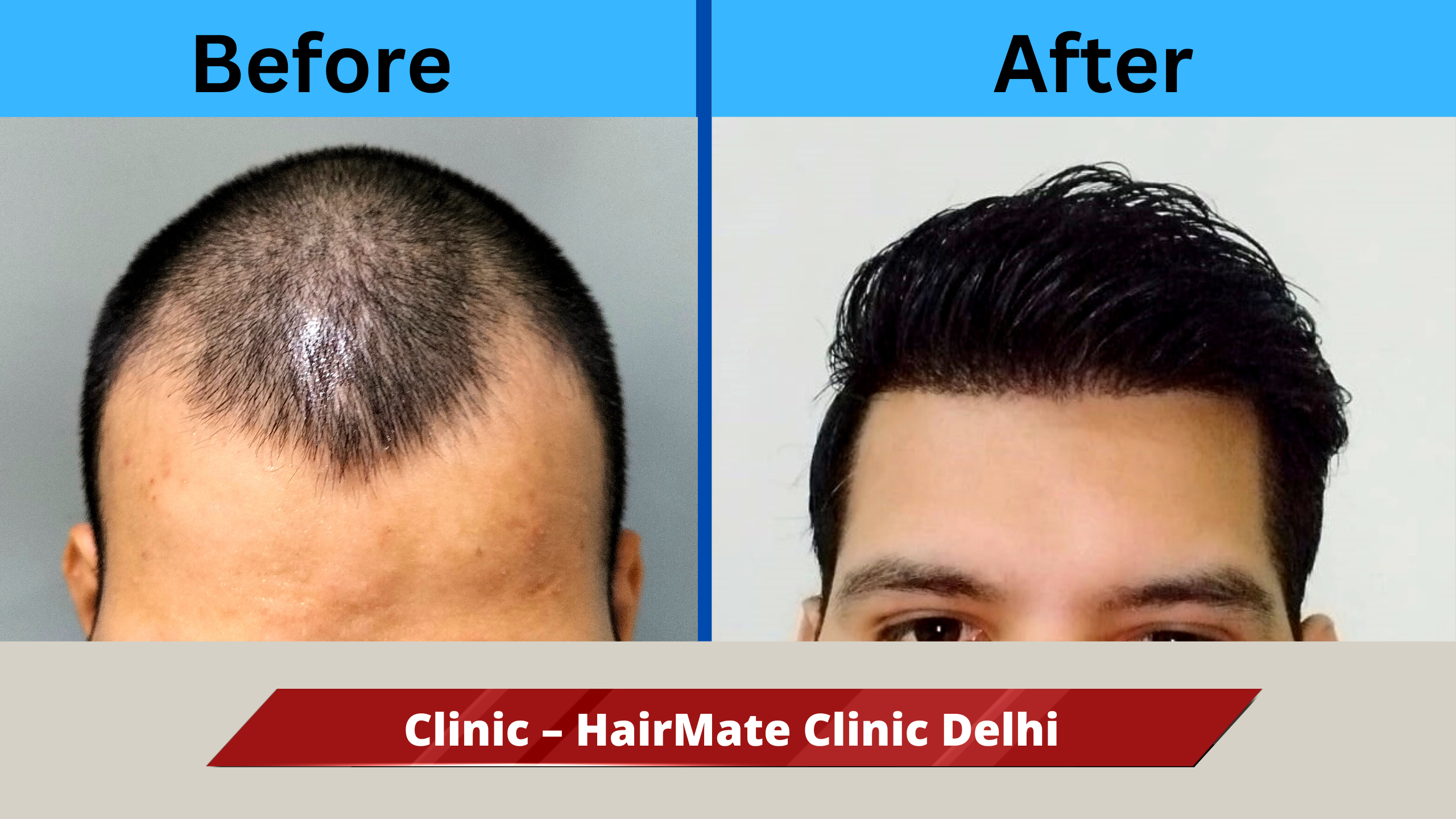 A Natural Hair Transplant Result From Delhi – Best Hair Help