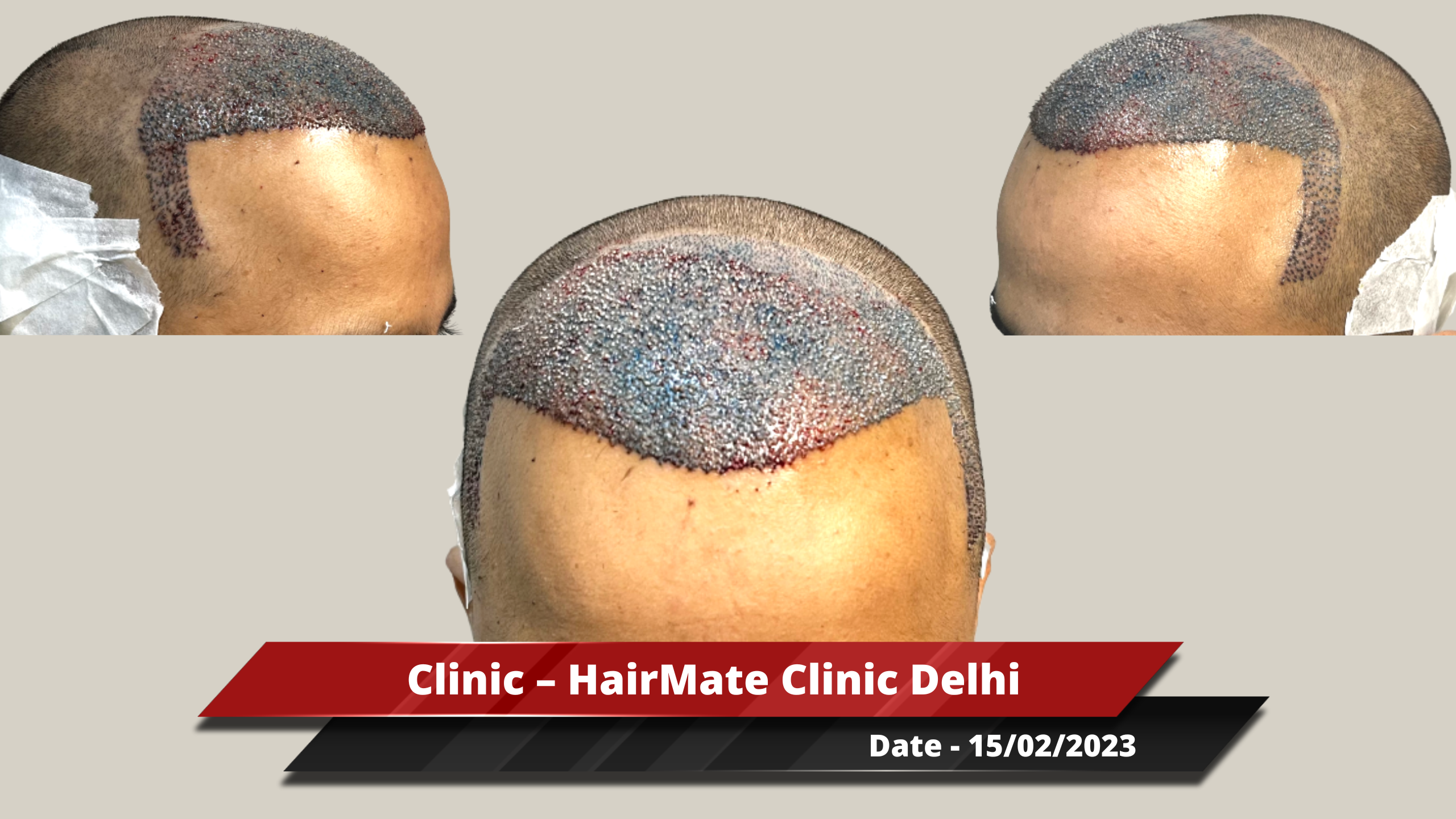 Hair Transplant from Delhi Clinic – 3500 Grafts – Best Hair Help