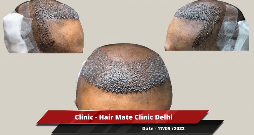 Clinic - Hair Mate Clinic Delhi-min