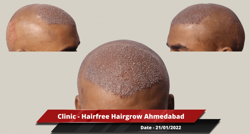 Clinic - Hairfree Hairgrow Ahmedabad 2-min