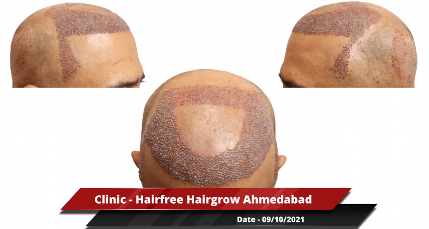 Clinic - Hairfree Hairgrow Ahmedabad 3-min