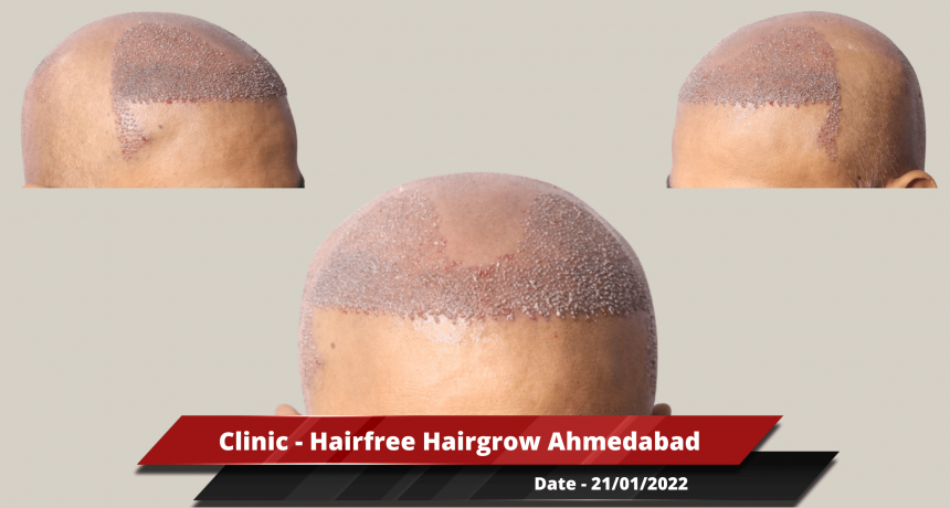 Clinic - Hairfree Hairgrow Ahmedabad-min