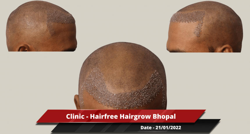 Clinic - Hairfree Hairgrow Bhopal-min