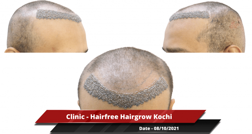 Clinic - Hairfree Hairgrow Kochi-min