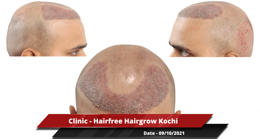 Clinic - Hairfree Hairgrow Kochi-min_1