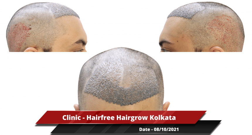 Clinic - Hairfree Hairgrow Kolkata 2-min