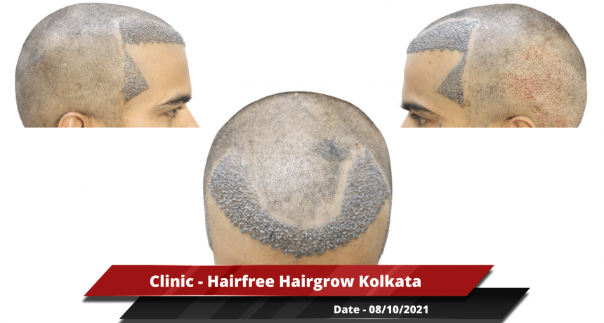 Clinic - Hairfree Hairgrow Kolkata-min