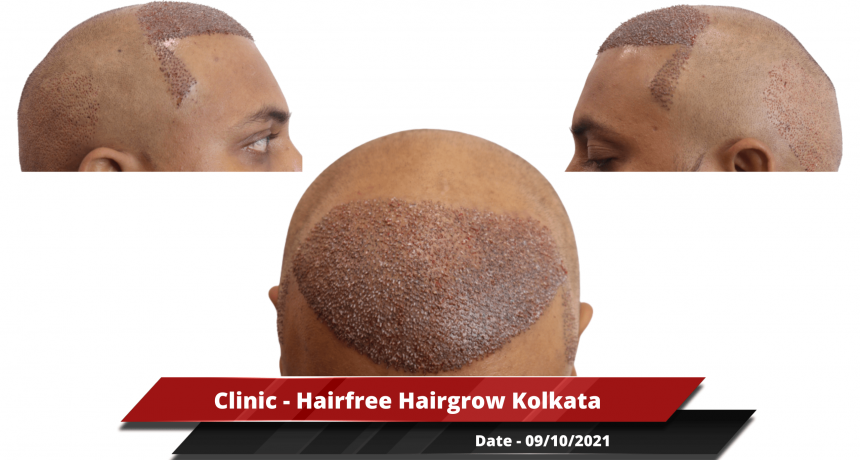 Clinic - Hairfree Hairgrow Kolkata-min_1
