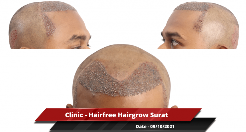 Clinic - Hairfree Hairgrow Surat 3-min